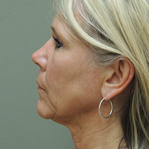 Laser Lift before and after photos