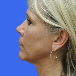 Laser Lift before and after photos