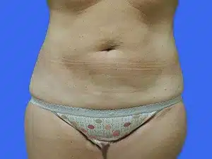 Liposuction before and after photos Liposuction before and after photos