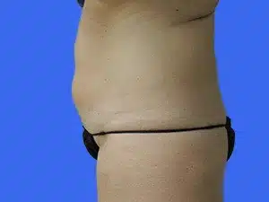 Liposuction before and after photos Liposuction before and after photos