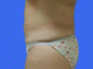 Liposuction before and after photos Liposuction before and after photos