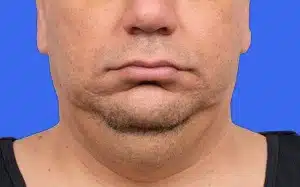 CoolSculpting before and after photos CoolSculpting before and after photos