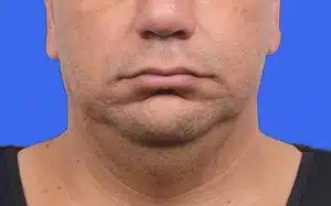 CoolSculpting before and after photos CoolSculpting before and after photos