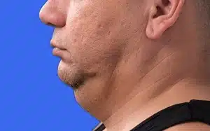 CoolSculpting before and after photos CoolSculpting before and after photos