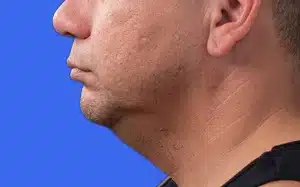 CoolSculpting before and after photos CoolSculpting before and after photos