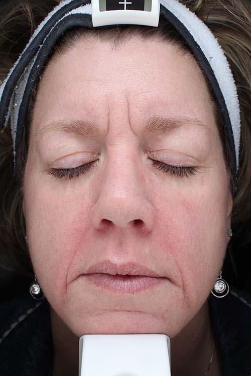 Summer Glow With Halo Pro 3 Halo Pro After Photo By Des Moines Plastic Surgery In West Des Moines, Ia