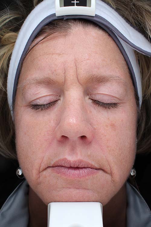 Summer Glow With Halo Pro 2 Halo Pro Before Photo By Des Moines Plastic Surgery In West Des Moines, Ia