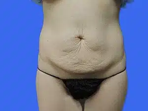 Tummy Tuck before and after photos Tummy Tuck before and after photos