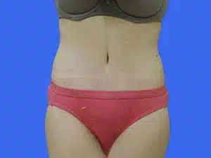 Tummy Tuck before and after photos Tummy Tuck before and after photos