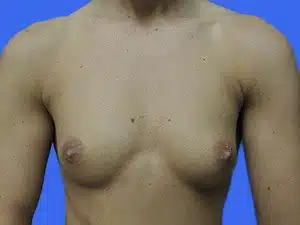 Breast Augmentation before and after photos Breast Augmentation before and after photos