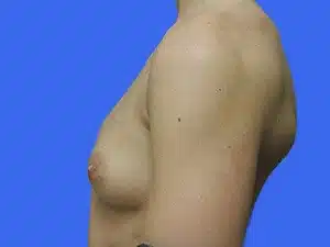 Breast Augmentation before and after photos Breast Augmentation before and after photos