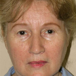 Face Lift before and after photos