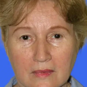 Face Lift before and after photos