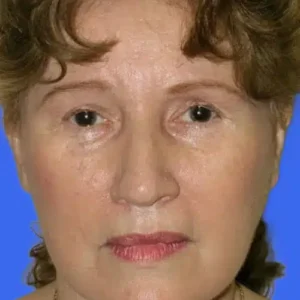 Face Lift before and after photos