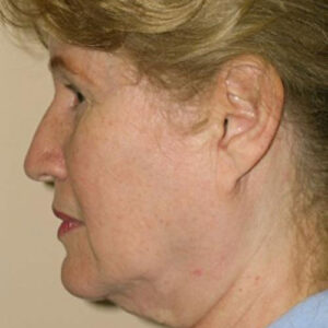 Face Lift before and after photos