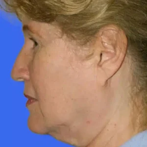 Face Lift before and after photos