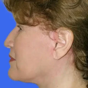 Face Lift before and after photos