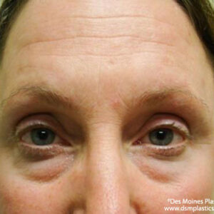 Eyelid Surgery before and after photos