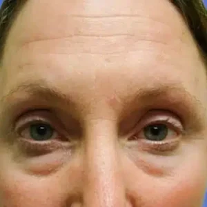 Eyelid Surgery before and after photos
