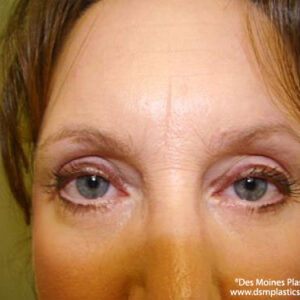 Eyelid Surgery before and after photos