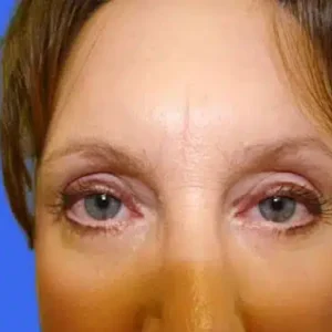 Eyelid Surgery before and after photos