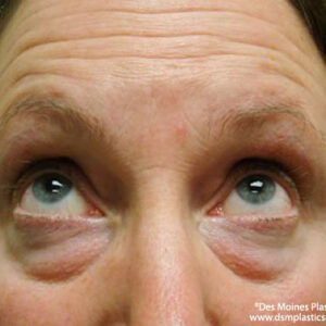 Eyelid Surgery before and after photos