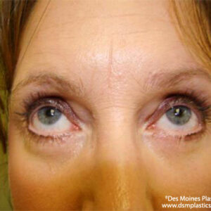 Eyelid Surgery before and after photos