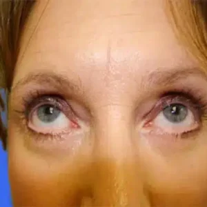 Eyelid Surgery before and after photos