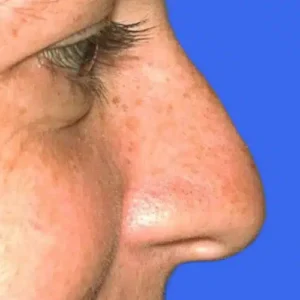 Rhinoplasty before and after photos