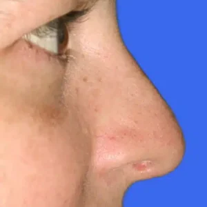Rhinoplasty before and after photos