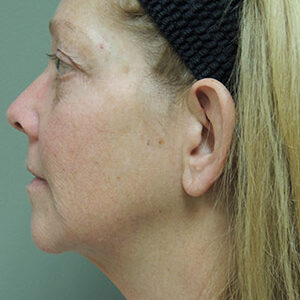 Laser Lift before and after photos