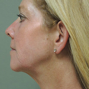Laser Lift before and after photos