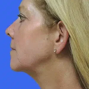 Laser Lift before and after photos