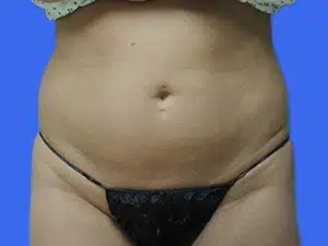 Liposuction before and after photos Liposuction before and after photos