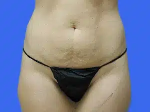 Tummy Tuck before and after photos Tummy Tuck before and after photos