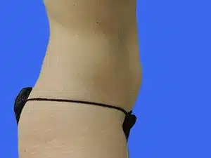 Tummy Tuck before and after photos Tummy Tuck before and after photos