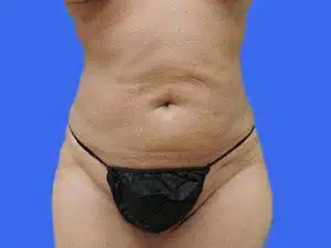 Liposuction before and after photos Liposuction before and after photos
