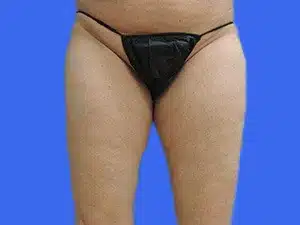 Liposuction before and after photos Liposuction before and after photos