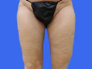 Liposuction before and after photos Liposuction before and after photos