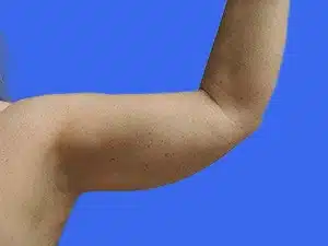 Liposuction before and after photos Liposuction before and after photos