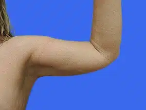 Liposuction before and after photos Liposuction before and after photos