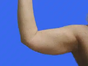 Liposuction before and after photos Liposuction before and after photos