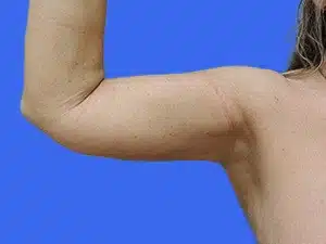 Liposuction before and after photos Liposuction before and after photos