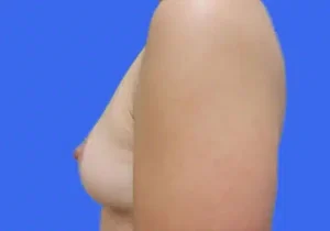 Breast Lift before and after photos Breast Lift before and after photos