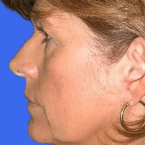 Face Lift before and after photos