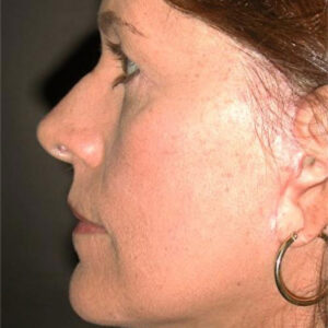 Face Lift before and after photos