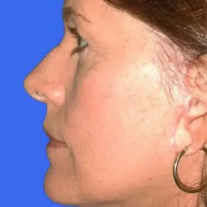 Face Lift before and after photos