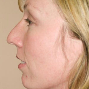 Rhinoplasty before and after photos