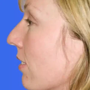 Rhinoplasty before and after photos