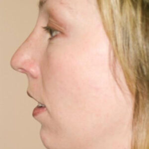 Rhinoplasty before and after photos